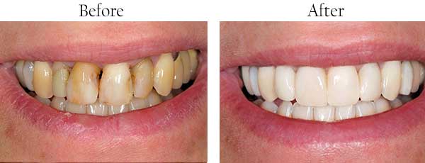 Menlo Park Before and After Teeth Whitening