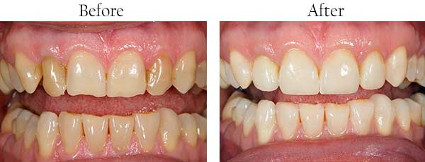 Atherton Before and After Smile Makeover